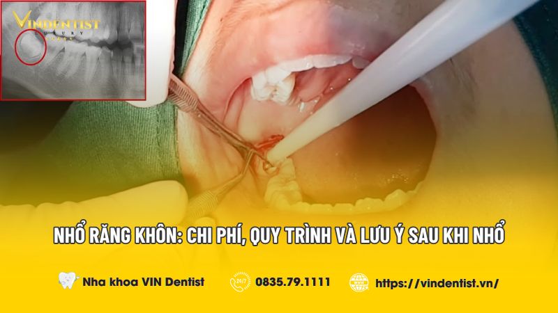 Nhổ Răng Khôn: Chi Phí, Quy trình và lưu ý sau khi nhổ