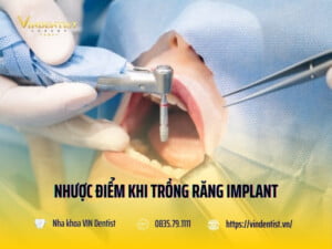 Nhược điểm khi trồng răng implant nên biết