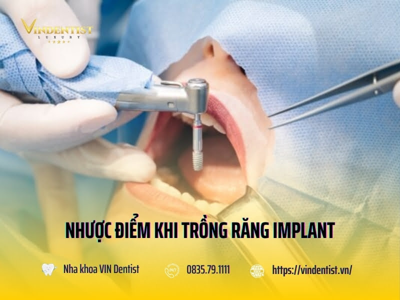 Nhược điểm khi trồng răng implant nên biết