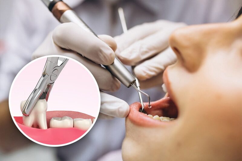 Nhổ Răng Khôn: Chi Phí, Quy trình và lưu ý sau khi nhổ 13 Quy trình nhổ răng khôn chuẩn y khoa