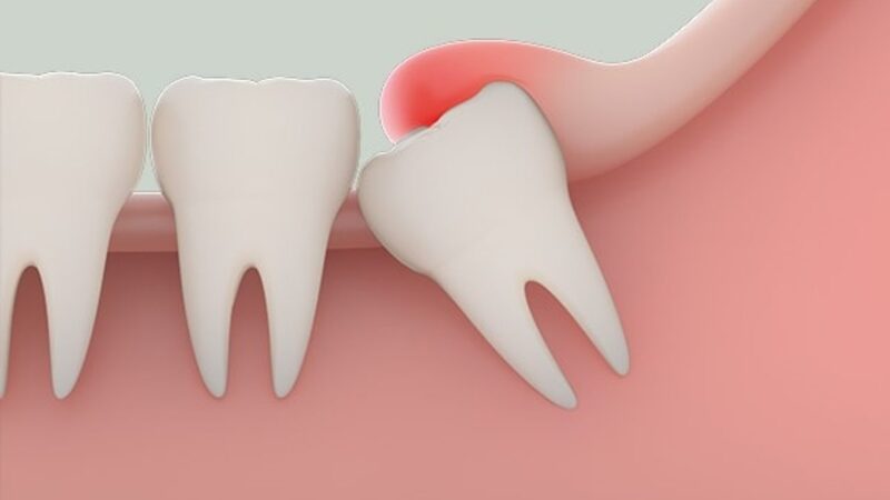 Nhổ Răng Khôn: Chi Phí, Quy trình và lưu ý sau khi nhổ 9 Răng khôn là gì?