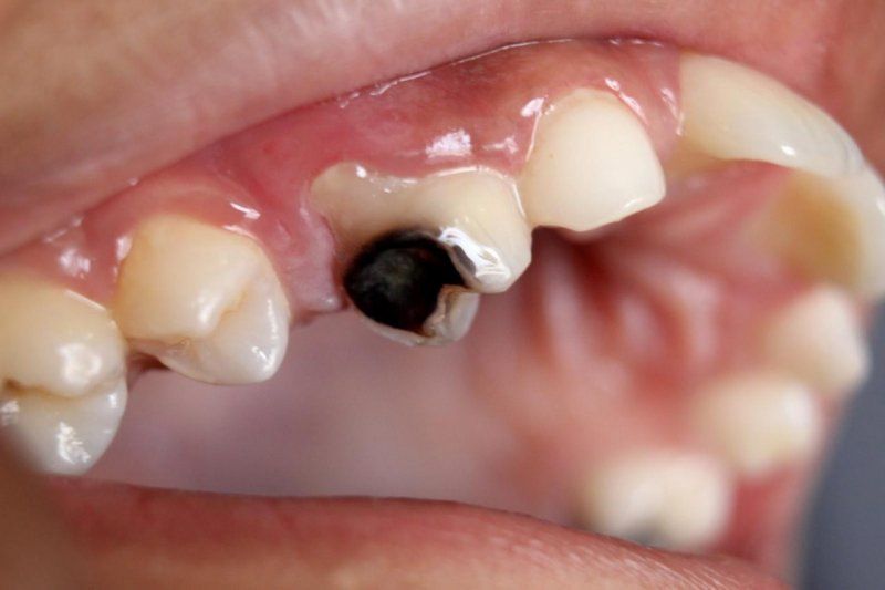 Trám Răng Sâu Bao Nhiêu Tiền? Có Bị Sâu Lại Không? 23 Răng sâu bị vỡ có trám được không?
