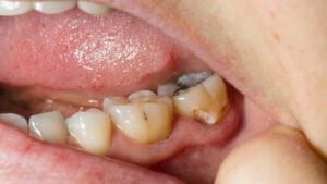 Tại sao phải điều trị tủy răng càng sớm càng tốt?