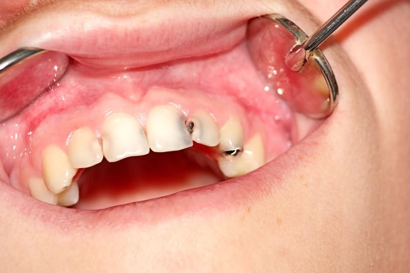 Trám Răng Sâu Bao Nhiêu Tiền? Có Bị Sâu Lại Không? 22 Răng cửa bị sâu có trám được không?