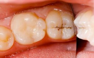 Trám răng rồi có bị sâu lại không?