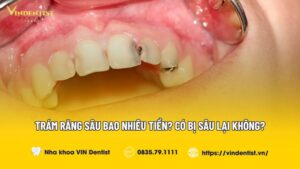 Trám Răng Sâu Bao Nhiêu Tiền? Có Bị Sâu Lại Không?