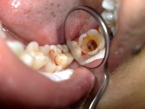 Trám răng sâu có lấy tủy không?