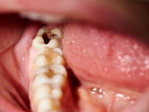 Trám răng sâu lỗ to có được không?