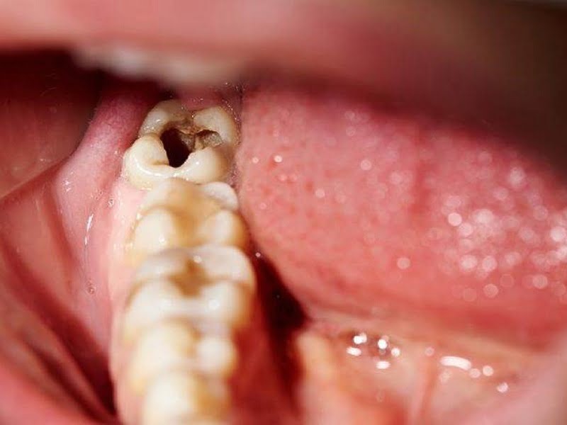 Trám Răng Sâu Bao Nhiêu Tiền? Có Bị Sâu Lại Không? 21 Trám răng sâu lỗ to có được không?