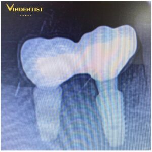 Trụ implant chất lượng cao