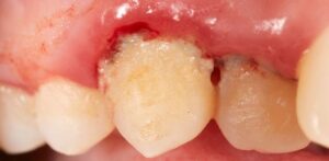 Viêm lợi loét hoại tử cấp tính