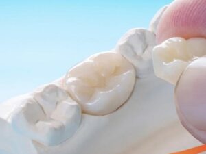 Bọc răng sứ để có hàm rằng đều và đẹp