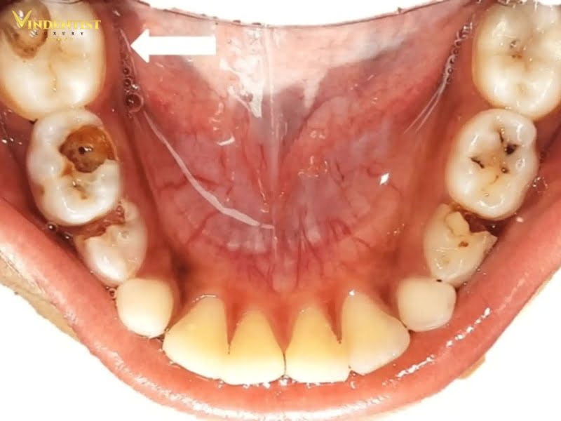 Thực trạng bệnh tình răng miệng của từng người