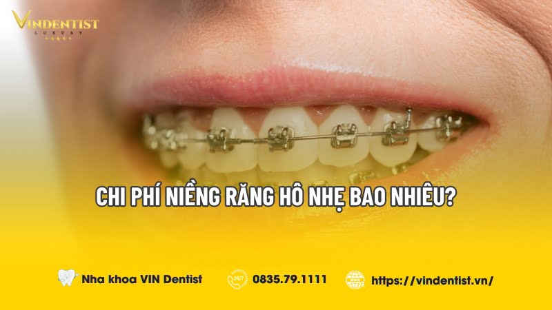 Giải đáp thắc mắc: Chi phí niềng răng hô nhẹ bao nhiêu?