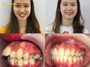 Minh họa rõ nét sự khác biệt của răng hô nhẹ sau khi niềng