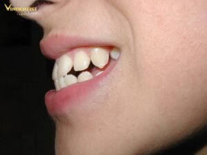 Răng hô hàm do yếu tố di truyền