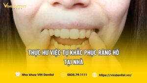 Thực Hư Việc Tự Khắc Phục Răng Hô Tại Nhà