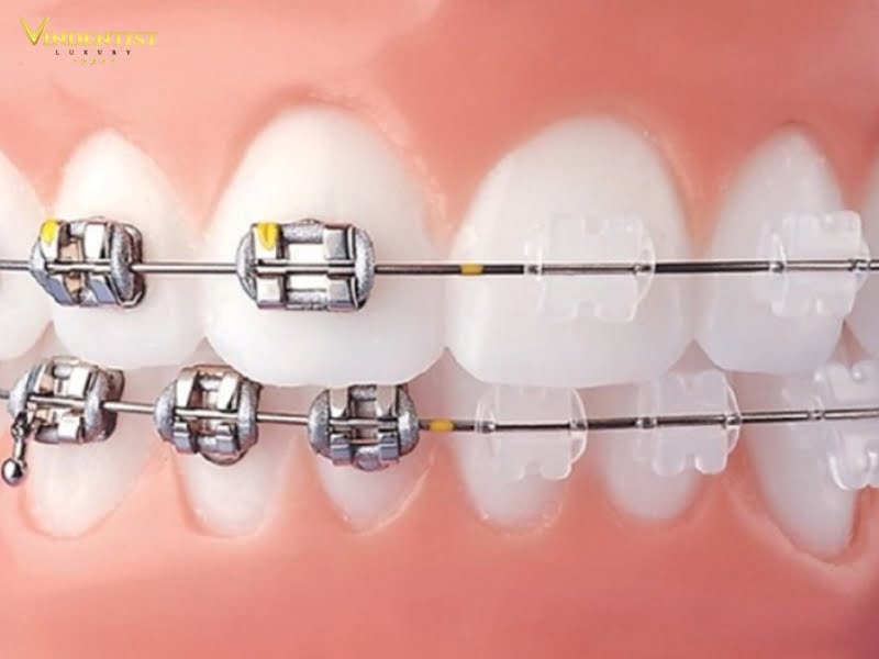 Loại hình niềng răng lựa chọn