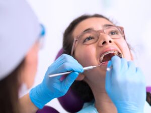 Niềng răng hô thẩm mỹ