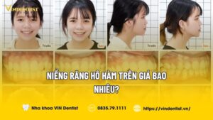 Niềng răng hô hàm trên giá bao nhiêu?