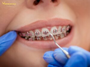 Niềng răng mắc cài