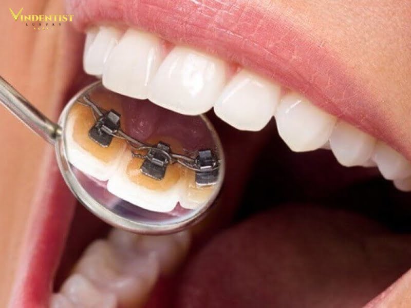Niềng răng hô nhẹ mặt trong