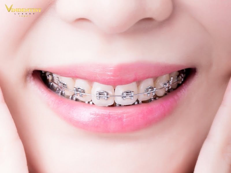 Niềng răng hô nhẹ mắc cài