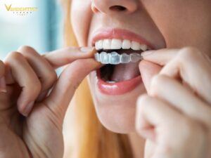 Niềng răng hô hàm trong suốt