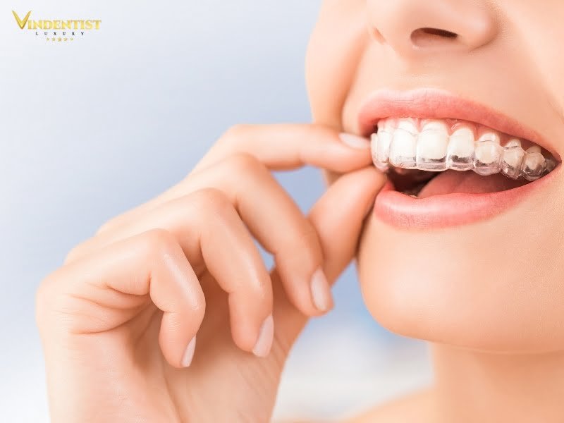 Niềng răng hô nhẹ trong suốt