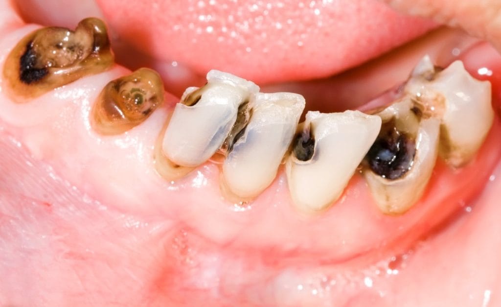 bệnh lý về răng sâu răng
