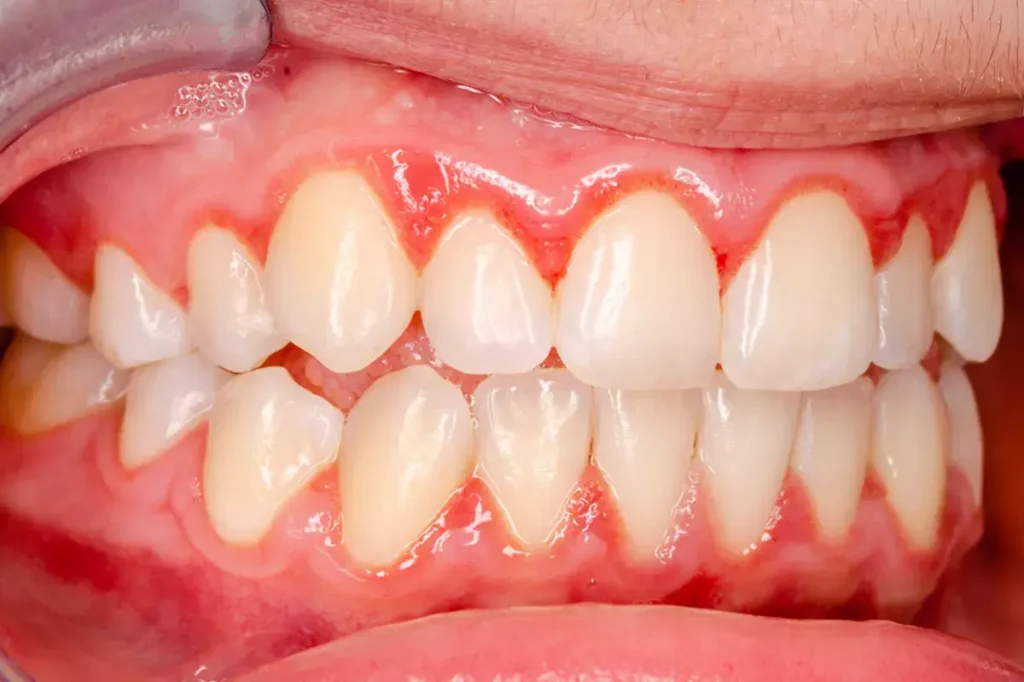 bệnh lý về răng viêm nướu