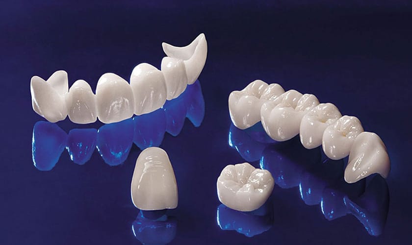 Răng sứ Cercon là gì? Có bao nhiêu loại răng sứ Cercon? 3 Nha Khoa VIN Dentist Đà Nẵng