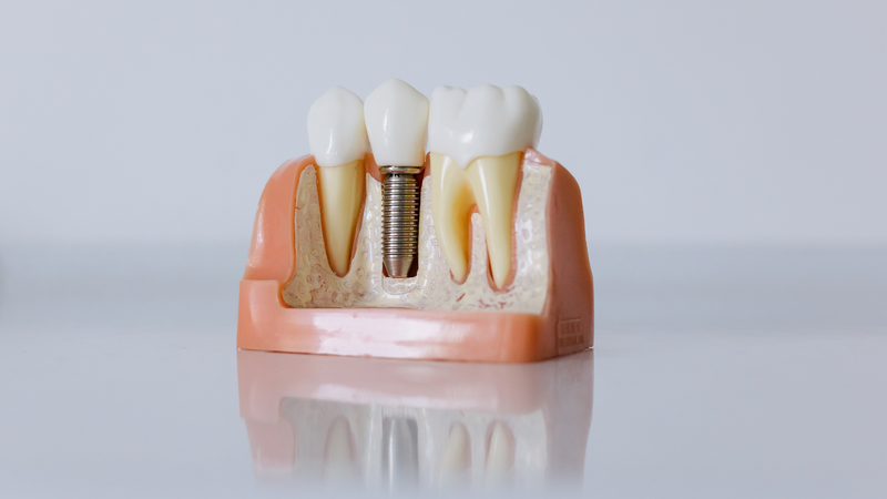 Implant Hiossen Mỹ - Khái niệm, lợi ích và chi phí 4 Nha Khoa VIN Dentist Đà Nẵng