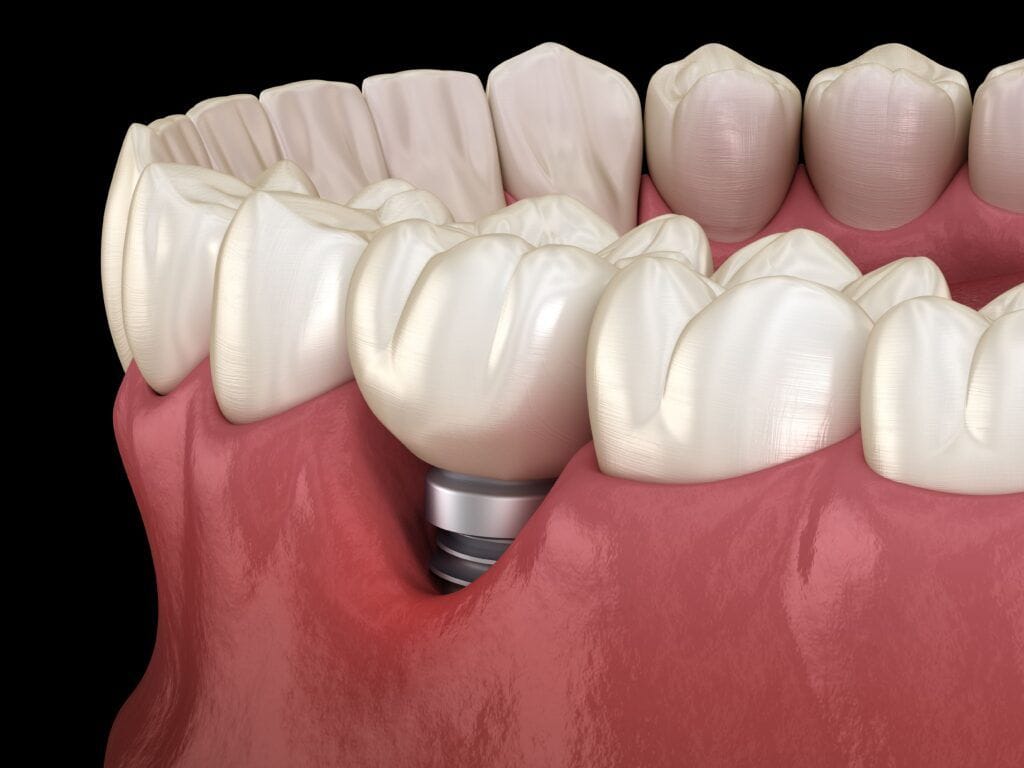 Implant Ritter Đức: Khái niệm, đặc điểm và chi phí 5 Nha Khoa VIN Dentist Đà Nẵng