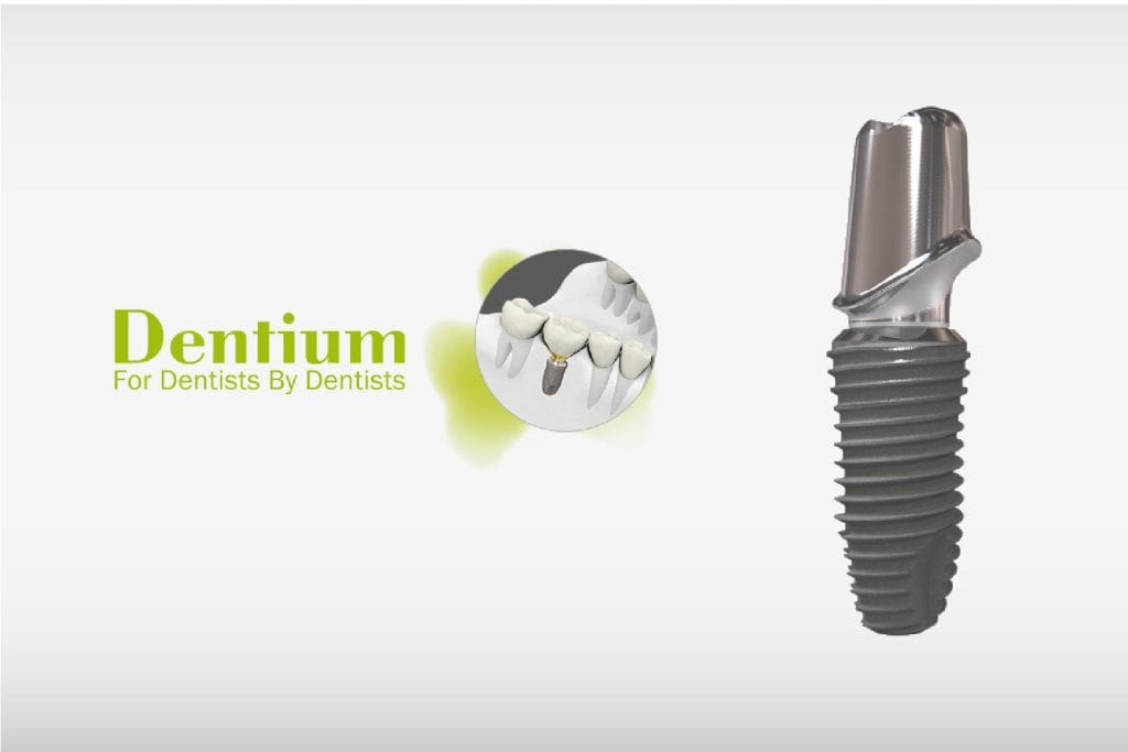Implant Dentium Hàn Quốc: Khái niệm, đặc điểm & chi phí 4 Nha Khoa VIN Dentist Đà Nẵng