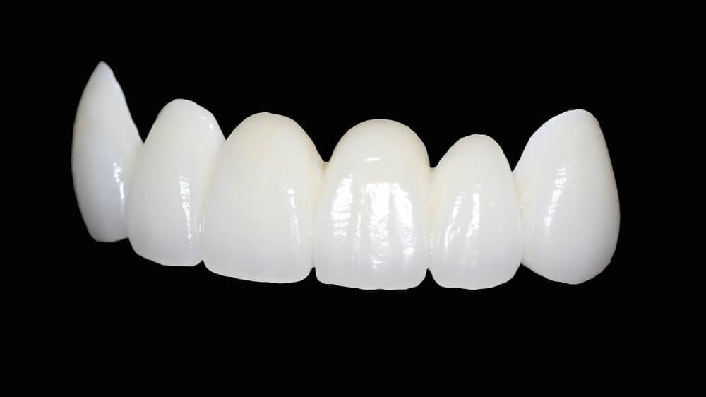 Răng sứ Zirconia là gì? Có bao nhiêu loại răng sứ Zirconia? 4 Nha Khoa VIN Dentist Đà Nẵng