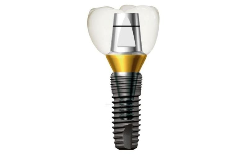 Implant Dentium Hàn Quốc: Khái niệm, đặc điểm & chi phí 5 Nha Khoa VIN Dentist Đà Nẵng