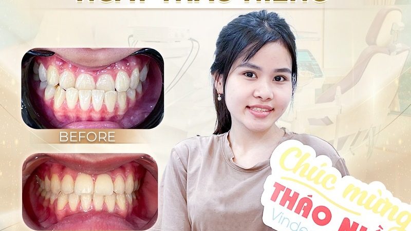 Kết quả niềng răng của khách hàng tại VIN Dentist